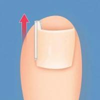 Kit De Prevención De Uñas Encarnadas Con Cortauñas Y Tiras Rellenas Para Uñas Y Almohadillas Ortopédicas Para El Cuidado De Los Pies - details 7
