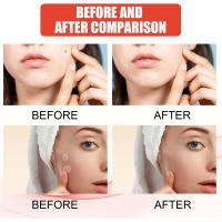 Set De 144 Parches De Acné Profesionales Para Cuidado De La Piel Alta Gama Absorciónde Espots Y Curación Covering Acne Herramientas De Cuidado Facial - details 6