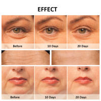 Masajeador Facial EMS Microcurrent LED Fotón Rejuvenecimiento Levantamiento Eliminador De Arrugas RF Alta Frecuencia Aparato De Belleza Multifuncional - details 10