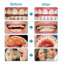 Purificador De Agua Ultrasonido Para Limpieza Dental Eliminador De Cal Y Placa Scraper De Ultrasonidos Para Dientes Recargable - details 5