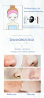 Limpieza Profunda De Pores Portátil Espátula Exfoliante Facial Ultrasonido Espátula De Piel Ultra Espátula De Cuidado De Piel - details 1