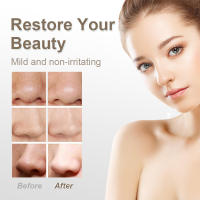 Removedor de poros faciales, instrumento de belleza, limpieza de puntos negros, succión eléctrica doméstica para acné. - details 5