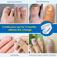 Dispositivo de lámpara de limpieza de hongos en las uñas, lámpara de fototerapia de uñas con pantalla digital, adecuada para uñas de los pies y uñas gruesas dañadas y descoloridas, removedor de hongos en las uñas recargable por USB para uso doméstico - details 2