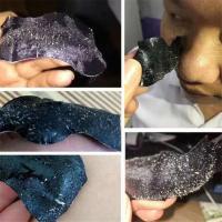 Mascarillas De Tratamiento Contra Acné Y Blackheads Profundo Limpieza Reducción De Poros 10PCS MDUG Sin Fuente Eléctrica Originales De China Continental - details 5