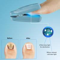Dispositivo De Láser Para Tratamiento De Uñas Fungosas Azul 7 Minutos Tratamientos Sin Dolor Curación De Onicomicosis Máquina 905nm LLLT Para Uñas Y Dedos - details 4