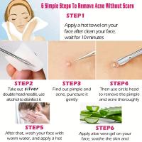 Kit Profesional De 5 Piezas Para Extraer Comedones Y Negros Con Pinzas Curvadas De Acero Inoxidable Herramientas Para Puntos Negros Y Acné - details 1