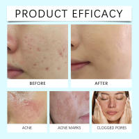 Gel limpiador para el acné OUHOE, gel hidratante con niacinamida para el acné, limpiador suave que reduce la grasa y atenúa el acné. - details 7