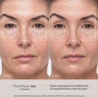 Therabody TheraFace PRO - Masajeador Facial, Dispositivo Avanzado Todo en Uno para Rejuvenecer y Relajar tu Piel con Terapia Percusiva, Microcorrientes, Luz LED y Limpieza Profunda, Reduce Tensión Facial y Mejora la Salud de tu Piell - details 1