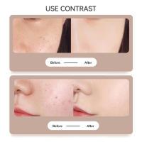 Laser Plasmático Para Eliminación De Verrugas Manchas De Piel Papilomas Tatuajes Herramienta De Cuidado Estético Molecula Hailicare - details 3