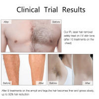 Profesional IPL Láser Eliminador De Vello Para Hombres Y Mujeres 990000 Chisporreos Peluca Piel Sensible Eliminación Permanente Para Todas Las Áreas Del Cuerpo - details 12