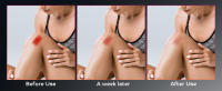 Dispositivo De Terapia De Luz Roja Para Tratamiento De Herpes Labial Y Heridas En La Boca Terapia Infrarroja Con Cabeza De Lámpara USB Para Cuidado Personal Y Belleza - details 3