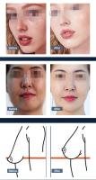 Dispositivo De Rejuvenecimiento Corporal Portátil 3 En 1 Anti-Aging Elevación Facial Y Ojos RF Máquina De Firmeza De La Piel Para El Torso - details 9