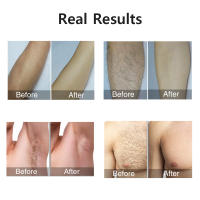 Epilador Láser Para Eliminación De Pelo 999999 Flashes Para Mujeres Y Hombres Eliminación De Pelo Corporal Piernas Axilas Bikini Facial Sin Dolor Depilador Láser Permanente - details 4