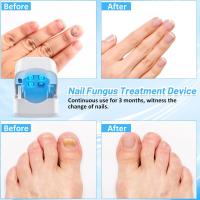 Dispositivo de Tratamiento de Hongos en las Uñas, Aparato de Tratamiento Láser de Hongos de Uñas Hongos de Uñas de Los pies Limpieza Reparación de Uñas Tratamiento de Hongos de Uñas. - details 0