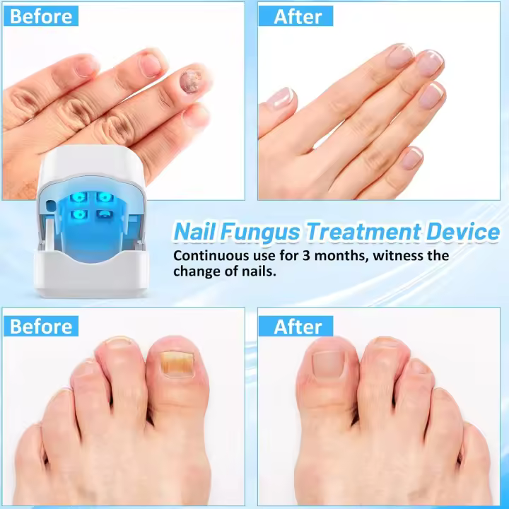 Dispositivo de Tratamiento de Hongos en las Uñas, Aparato de Tratamiento Láser de Hongos de Uñas Hongos de Uñas de Los pies Limpieza Reparación de Uñas Tratamiento de Hongos de Uñas. - 1