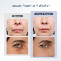 IBORRIA Aura2 Pro Radiofrecuencia Facial Multipolar 2MHz, Masajeador Facial Eléctrico con Microcorriente, Lifting y Rejuvenecimiento de la Piel, Cuidado Anti-Edad desde Casa (Azul) - details 1