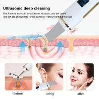 Limpieza Facial Profunda Con Scrubber Ultrasonido Eliminador De Quistes Faciales Y Puntos Negros Espátula De Poros Ultrasonido Scrubber De Piel Recargable - details 5