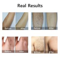 Profesional IPL Láser Eliminador De Vello Para Hombres Y Mujeres 990000 Chisporreos Peluca Piel Sensible Eliminación Permanente Para Todas Las Áreas Del Cuerpo - details 18