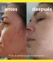 Goah Clinic ACNELIT 60 Cápsulas - Mantenimiento de la Piel - details 3