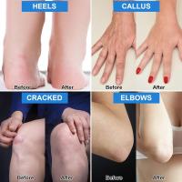 Crema de 7,06 onzas / urea 42% más ácido hidrofólico 2%, crema de pies de urea para el cuidado de los pies, talón agrietado para el tratamiento de la reparación de las manos de la rodilla y el codo, crema hidratante de los pies, piel muerta de callos de p - details 2