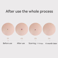 Laser Plasmático Para Eliminación De Verrugas Manchas De Piel Papilomas Tatuajes Herramienta De Cuidado Estético Molecula Hailicare - details 5