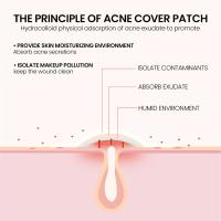 200pcs Parches De Estrella Para Acné Invisibles Eliminador De Manchas De La Piel Hidratante Y Aclarador Para El Rostro Herramientas De Belleza Y Cuidado De La Piel - details 13