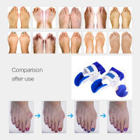 Corrector De Tornejo Ortopédico Para Aliviar El Dolor En El Pie Herramienta De Cuidado Del Pie Corrección De Hallux Valgus Tamaño a Pair Material ABS - details 8