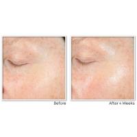 RoC Vitamin C Gel Cream Before & After