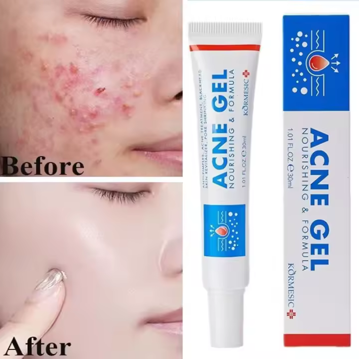 Crema Reparadora de Acné Efectiva Control de Aceite de Poros, Hidratación, Limpieza Profunda - 1