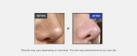 microneedle, Zero exosome shot, Lacto exosome, instant pore-tightening care, Pore Refining serum