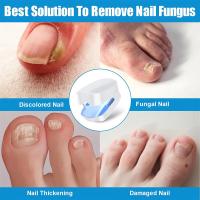 Dispositivo de tratamiento láser de hongos para uñas, reparación de hongos en las uñas de los pies, tratamiento de onicomicosis, relajación de hongos - details 6
