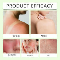 Gel calmante de aloe para el cuidado de la piel después de quemaduras solares - details 8