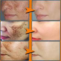 Crema Blanqueadora Efectiva para Manchas Negras Anti-Manchas, Desvanecimiento de Pigmentación, Iluminación del Piel Herramienta de Cuidado de la Piel Corporal de Belleza - details 4