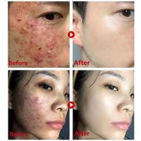 Té verde Original, elimina profundamente los puntos negros, mascarilla de barro para acné, palo, reduce los poros, disipa la crema para el acné, trata las espinillas, cuidado coreano de la piel limpia - details 9