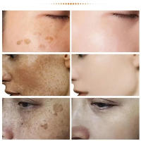 Crema iluminadora de niacinamida y Melasma, crema iluminadora de melanina, aclara la piel oscura, suero de cloasma que desvanece las líneas finas, cuidado facial - details 2