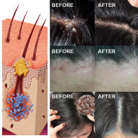 Cuero cabelludo limpieza profunda folículos caspa reparación cabello suavizante esencia de cuidado - details 7