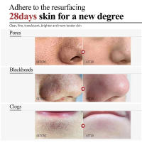 Crema Reductora de Poros de Ácido Salicílico Eliminación Rápida de Pimientas Piel Suave y Lisa - details 10