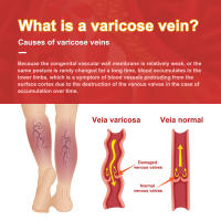 Parche para alivio de venas, parche para varices, bulto de venas, lombriz de tierra, reparación de piernas, parche para el dolor de hinchazón de piernas - details 6