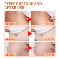 Desaliniza el cuerpo, reparación de cicatrices de embarazo, crema suave y nutritiva para el cuidado de la piel - details 8