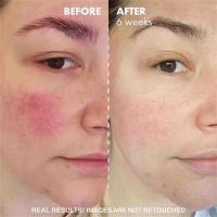 Crema reparadora de enrojecimiento Facial, mejora la sequedad de la piel sensible, loción hidratante, eliminación de rosácea, Cosméticos Coreanos - details 1