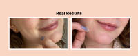 real results suck gunk out pimples whiteheads fast healing adhesive leave on overnight reduce size