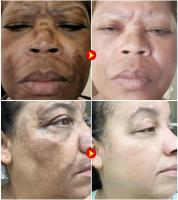 Potente crema blanqueadora que elimina manchas, ilumina la piel, elimina rápidamente la pigmentación de melanina, melasma, manchas oscuras, cuidado de la piel coreano - details 0