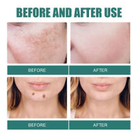 Crema iluminadora de niacinamida y Melasma, crema iluminadora de melanina, aclara la piel oscura, suero de cloasma que desvanece las líneas finas, cuidado facial - details 4
