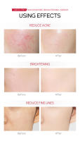 Suero Niacinamida con Zinc 1% Desvanece las Manchas Faciales, Reduce las Arrugas 17ML - details 7