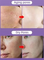 Crema de reducción de poros con ácido salicílico, eliminación rápida de poros grandes, elimina puntos negros, aprieta la cara, piel suave, producto de cuidado coreano - details 1