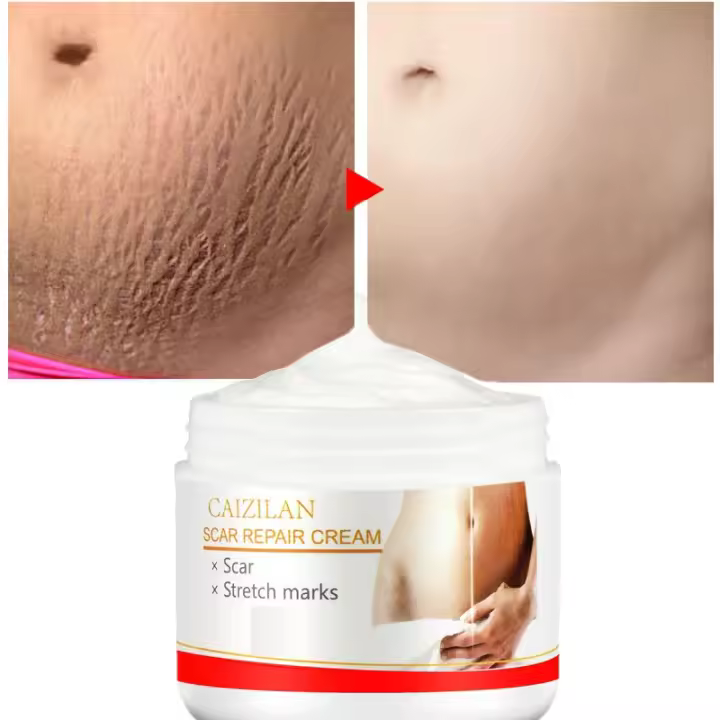 Crema de Reparación de Escaras Tratamiento Eficaz para Marcas de Embarazo - 1