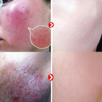 7X suero calmante para enrojecimiento Facial, tratamiento instantáneo de rosácea, venas de sangre rojas, mejora la reparación de la barrera de la piel sensible, cosméticos Coreanos - details 0