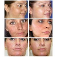 Crema iluminadora facial, niacinamida, Reduce el cloasma, melasma, melanina, desvanece las líneas finas, aclara la piel oscura, suero para el cuidado, crema iluminadora - details 8