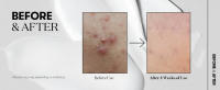 VT COSMETICS CICA Reedle Shot 100, suero con microagujas Spicule para el cuidado y exfoliación de los poros, exosoma, Centella Asiatica para vidrio - details 4