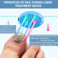 Dispositivo de tratamiento láser de hongos para uñas, reparación de hongos en las uñas de los pies, tratamiento de onicomicosis, relajación de hongos - details 3